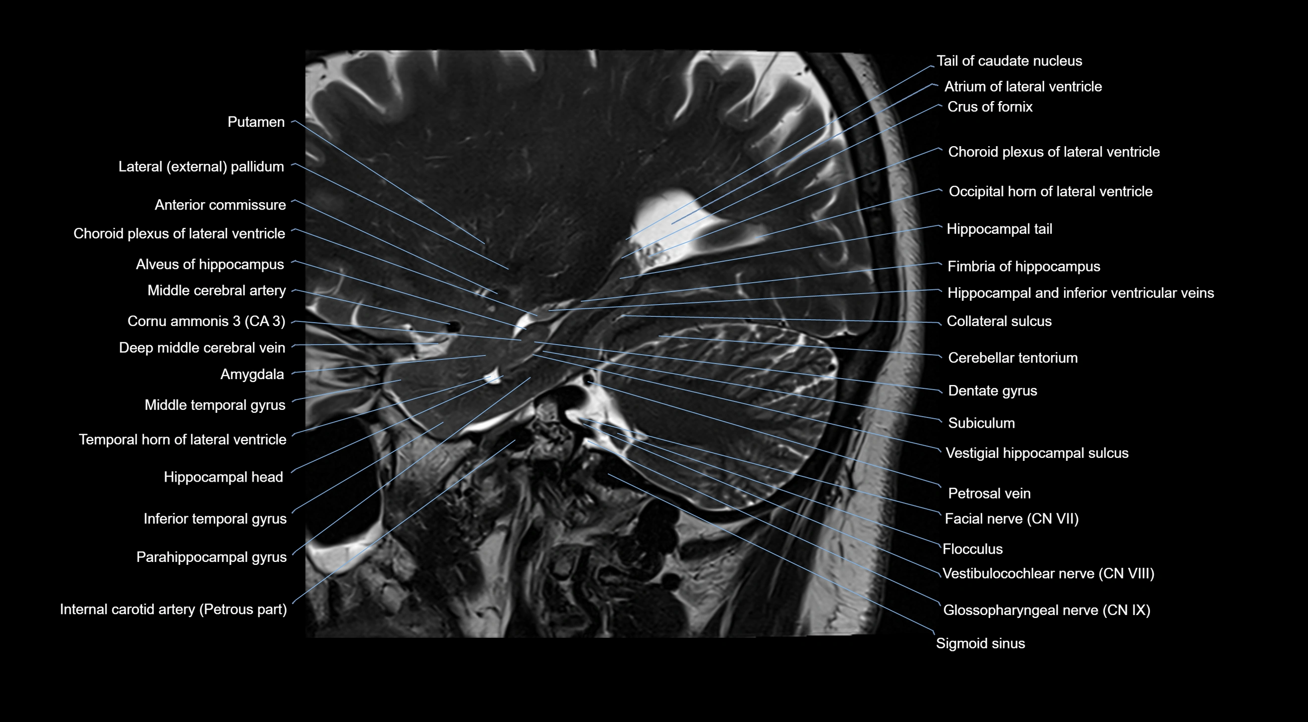 MRI brainstem & basal ganglia anatomy labelled  3T MRI images -img-10001-00013.webp